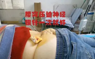 Descargar video: 大腿疼痛！睡觉困难！银针疗法，一次就好