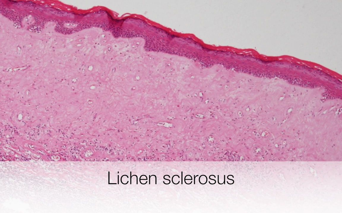 【皮肤病理】硬化性苔藓Lichen Sclerosus  Pathology mini tutorial哔哩哔哩bilibili