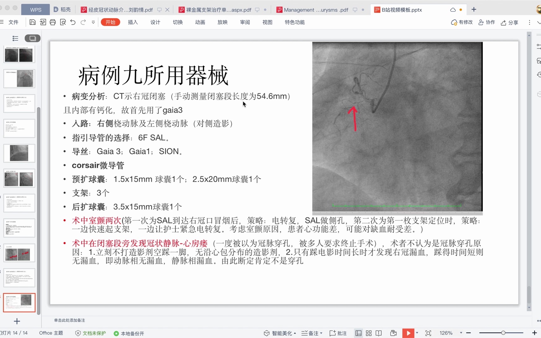 病例九:极其考验术者魄力及临场判断力的右冠CTO(下)哔哩哔哩bilibili