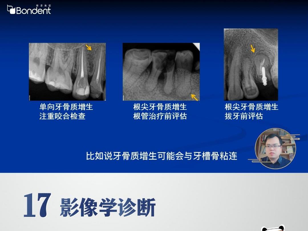 牙骨质瘤影像图片图片