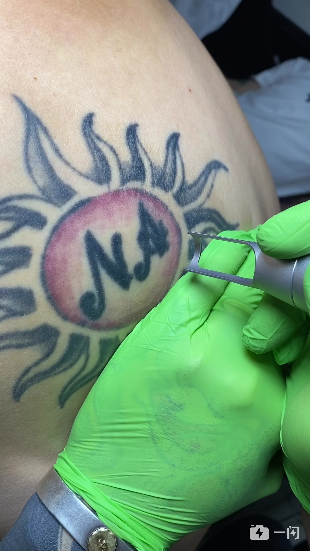 皮秒激光洗纹身