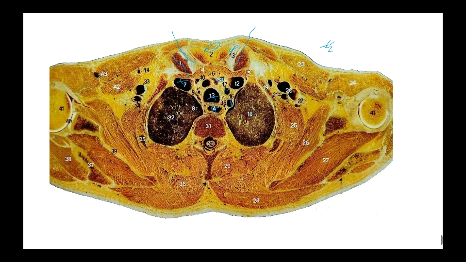 学习胸部CT基础断层解剖 经胸锁关节的横断层(2)哔哩哔哩bilibili