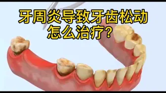 Descargar video: 牙周炎导致牙齿松动怎么办？