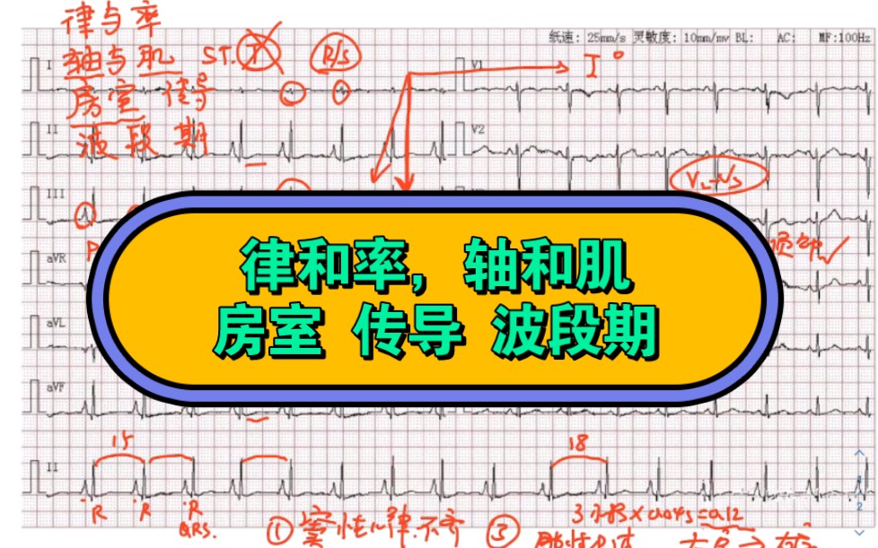 心电图诊断顺序口诀 窦性心律不齐,肺性p波,t波低平哔哩哔哩bilibili