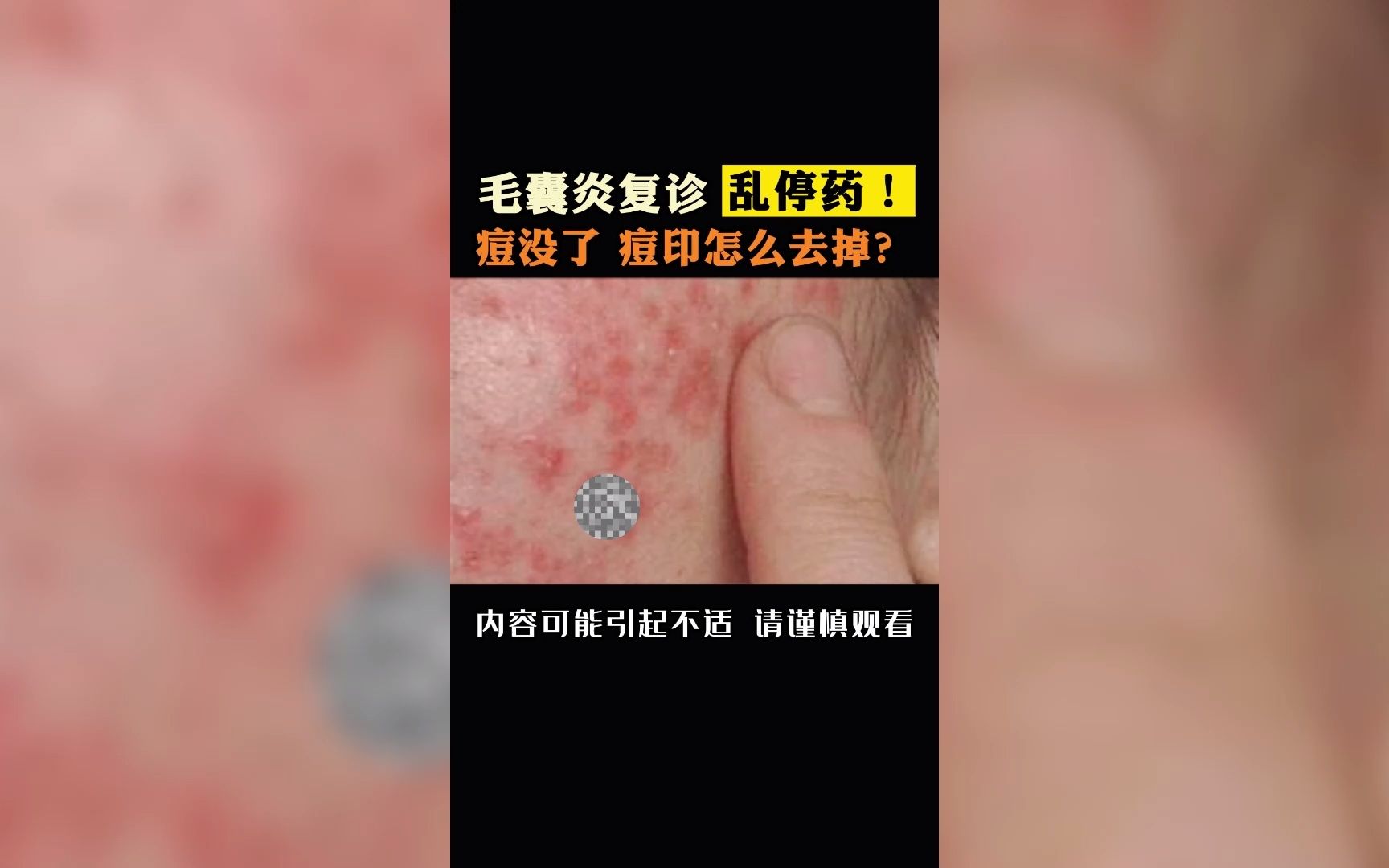 毛囊炎複診痘痘都沒了但還有痘印