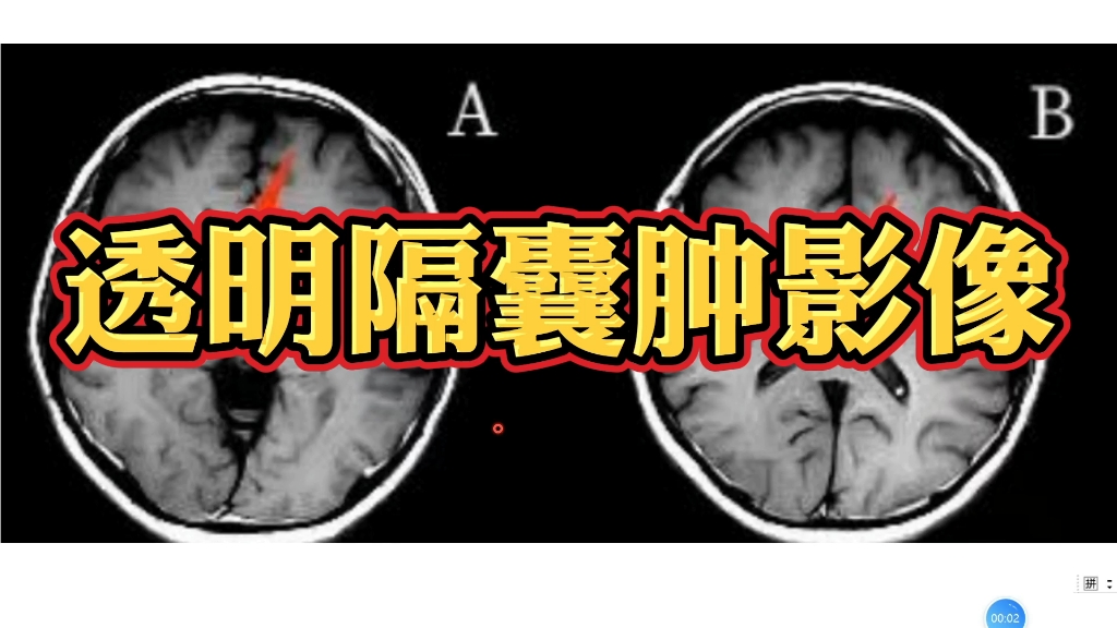 [图]透明隔增宽、透明隔囊肿影像上如何诊断？医生讲解！