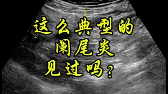 Descargar video: 这么典型的阑尾炎见过吗？