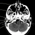 2.颅脑CT解剖图谱-颅底诸孔CT解剖