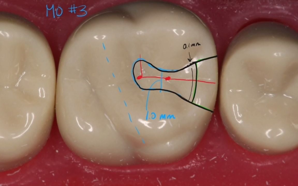 ii类洞制备完全教学