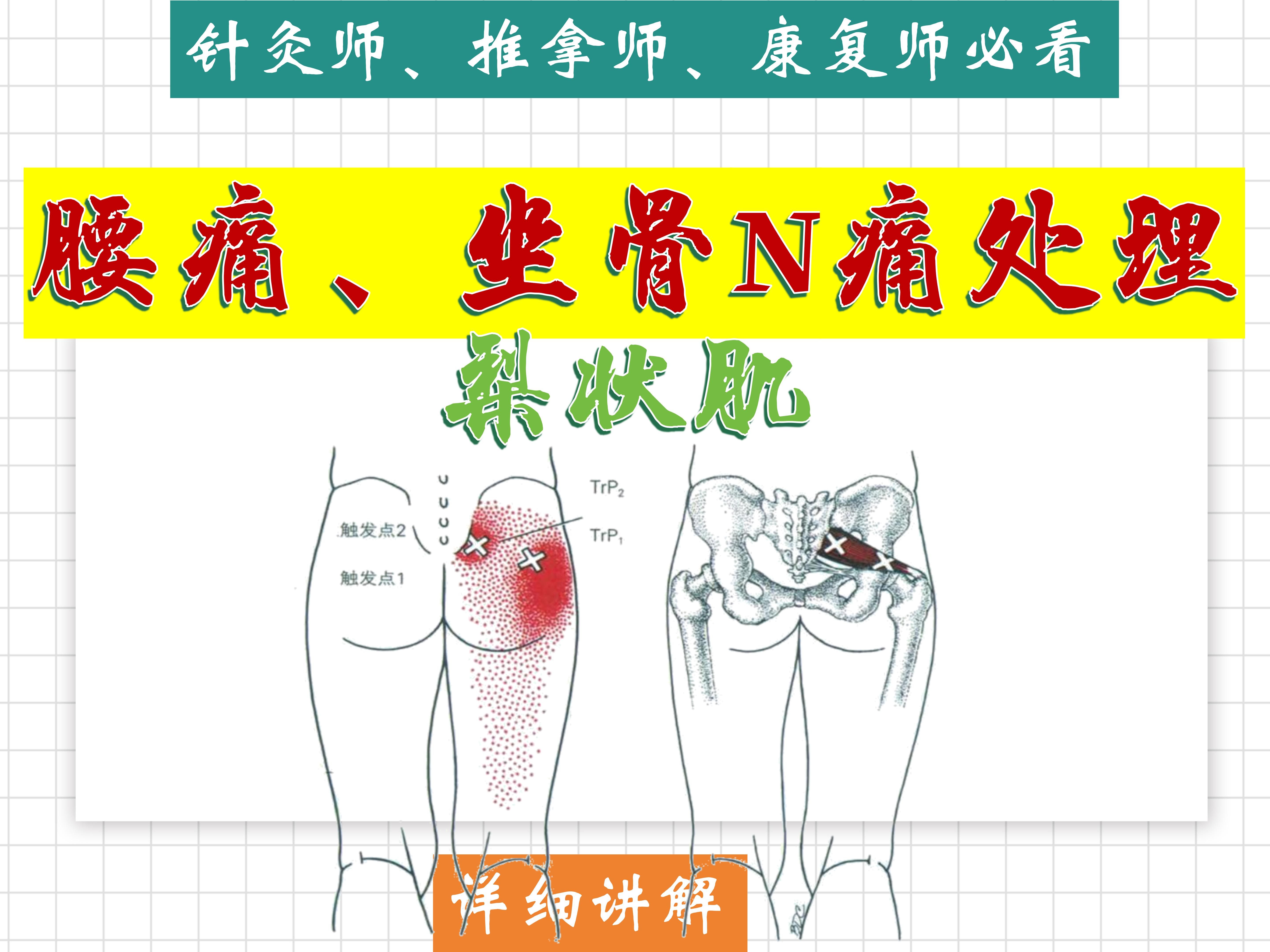 【腰痛、坐骨N痛】的的处理方案8涉及肌肉(梨状肌)详细讲解——位置、功能、激痛点、处理方法——天下明医平台简灵奇针哔哩哔哩bilibili