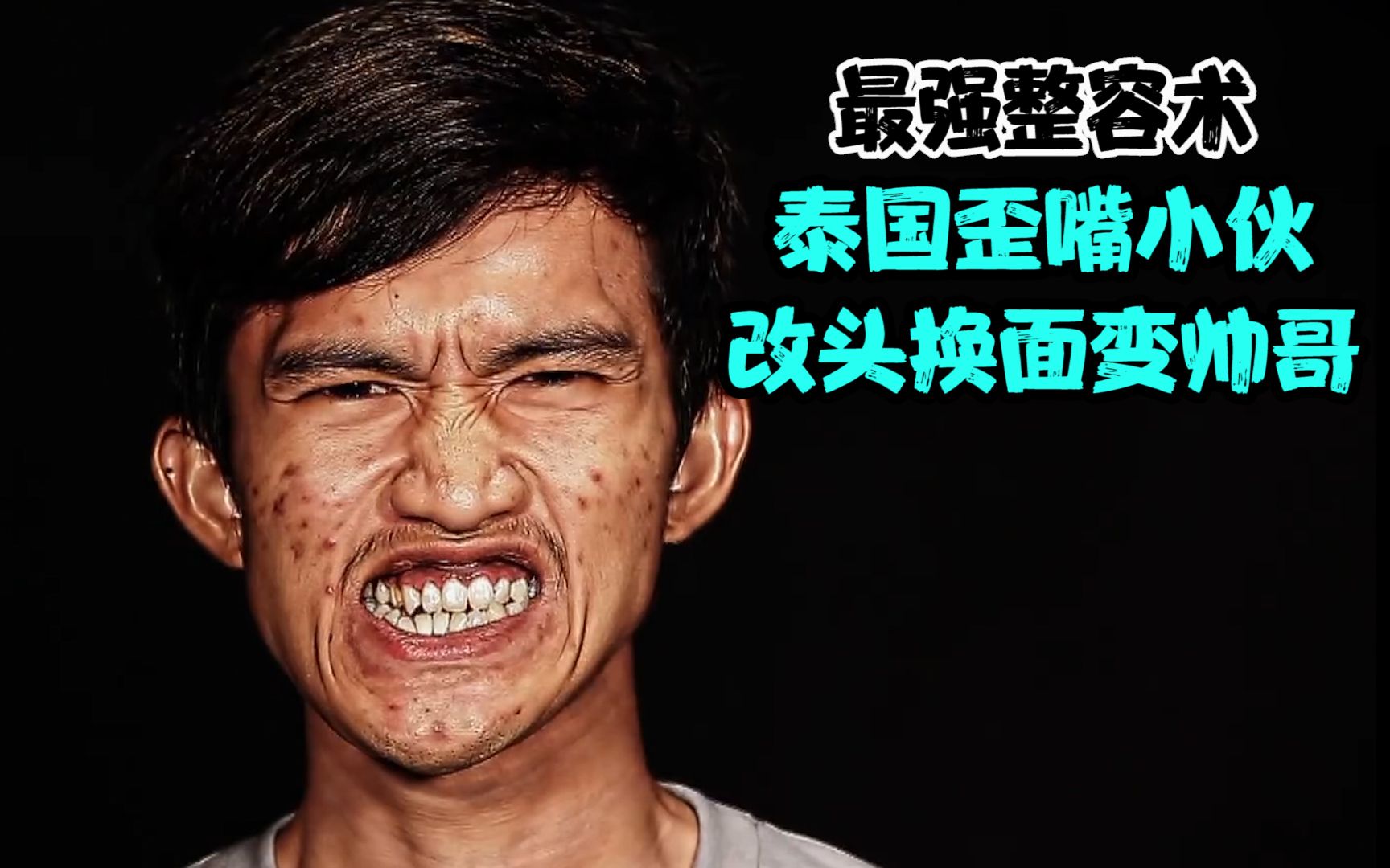 最强整容术,泰国歪嘴小伙为了女友,改头换面变帅哥