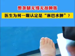 Download Video: 女子整条腿无缘无故肿胀！医生为何一眼认定是“淋巴水肿”？