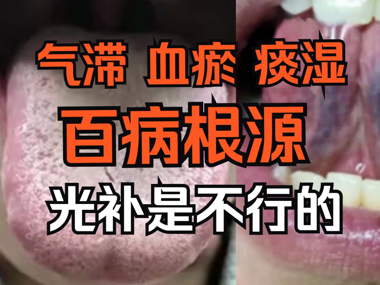 舌诊分析:气滞血瘀 痰湿=百病根源,光补是不行的,要通!