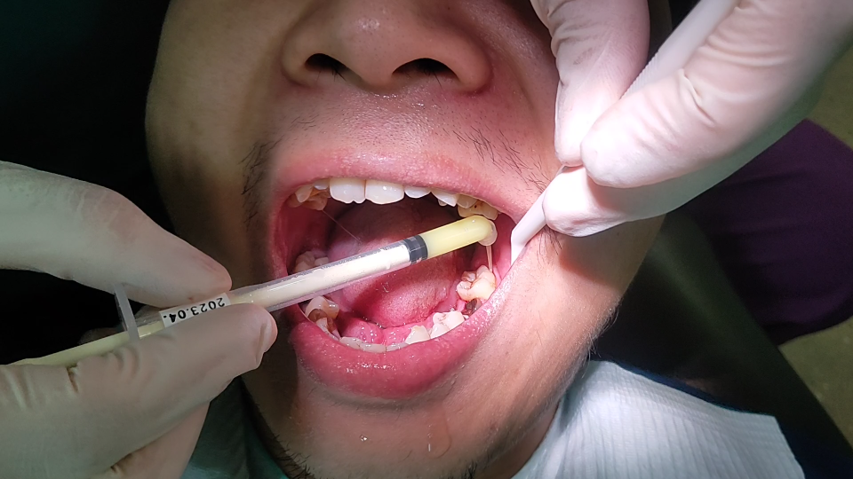 一定要爱护好牙齿这可太遭罪了先是拔牙神经这又要刮牙龈这谁顶得住