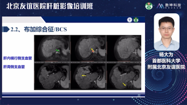 杨大为肝脏血管病变的影像诊断思路哔哩哔哩bilibili