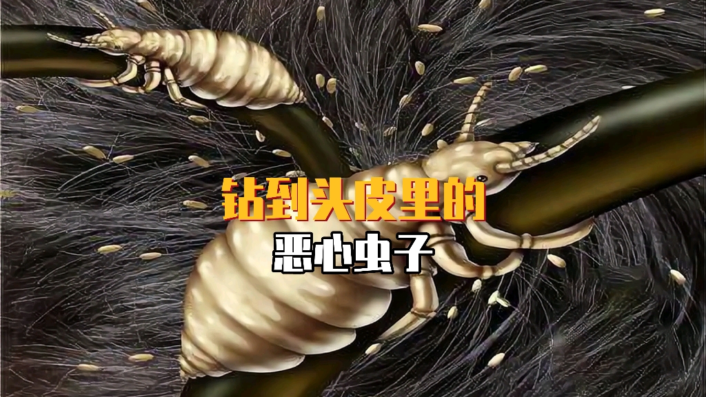 钻到头皮里的恶心虫子