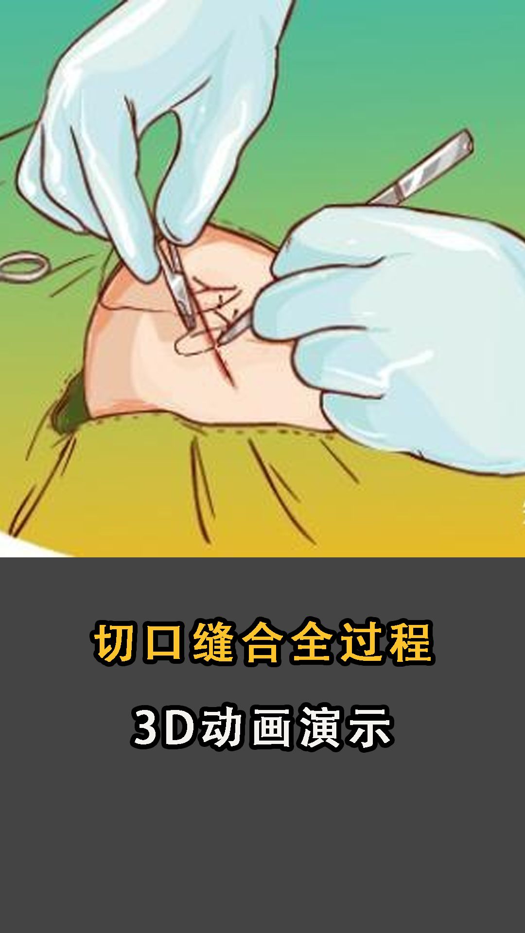 切口缝合知识医学科普哔哩哔哩bilibili