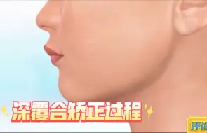 Download Video: 深覆合矫正动画过程3D动画