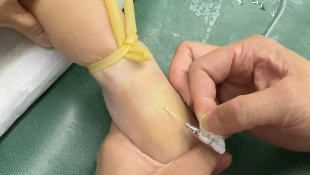 小儿静脉留置针日常分享