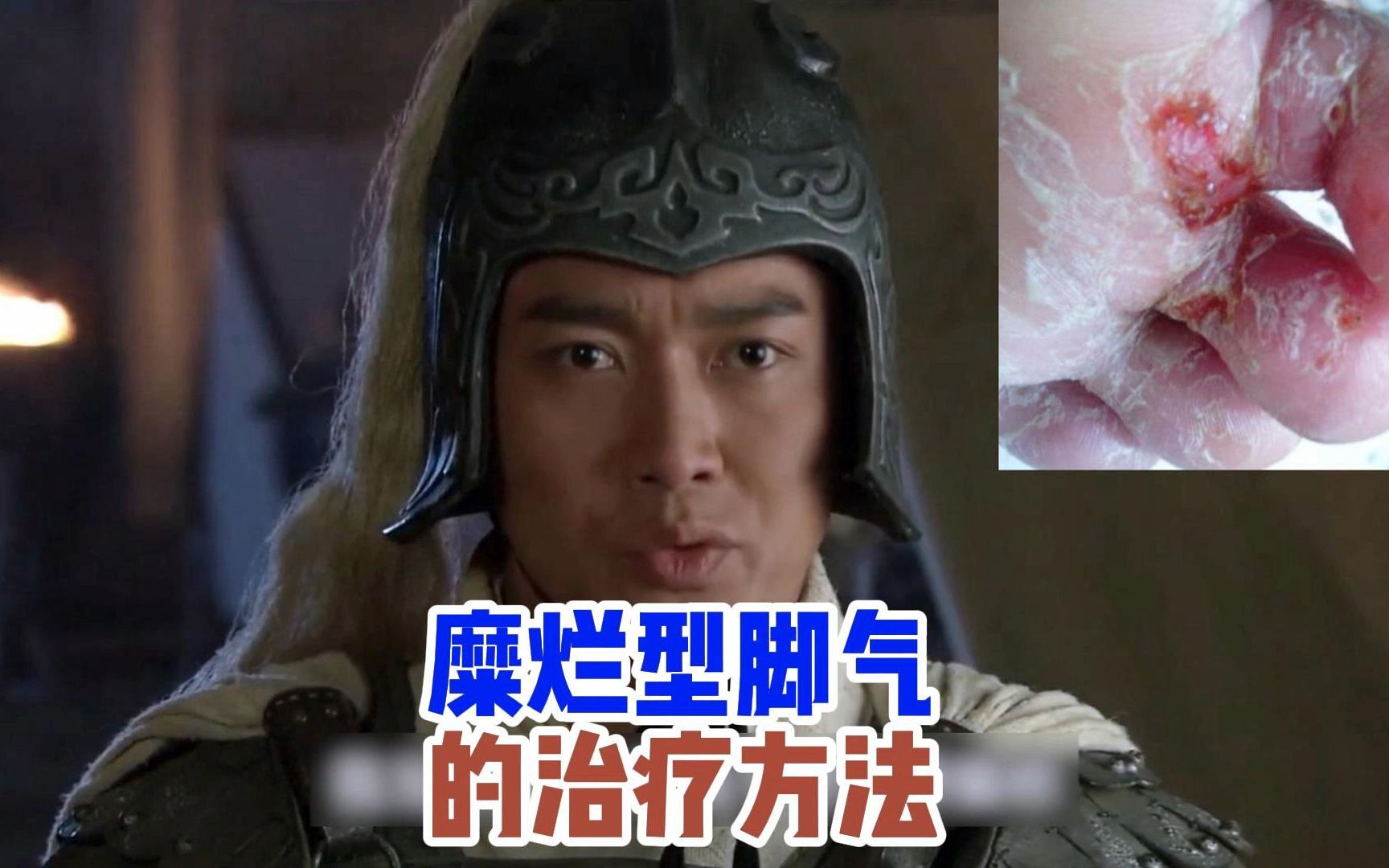 7月11日糜烂型脚气的治疗方法