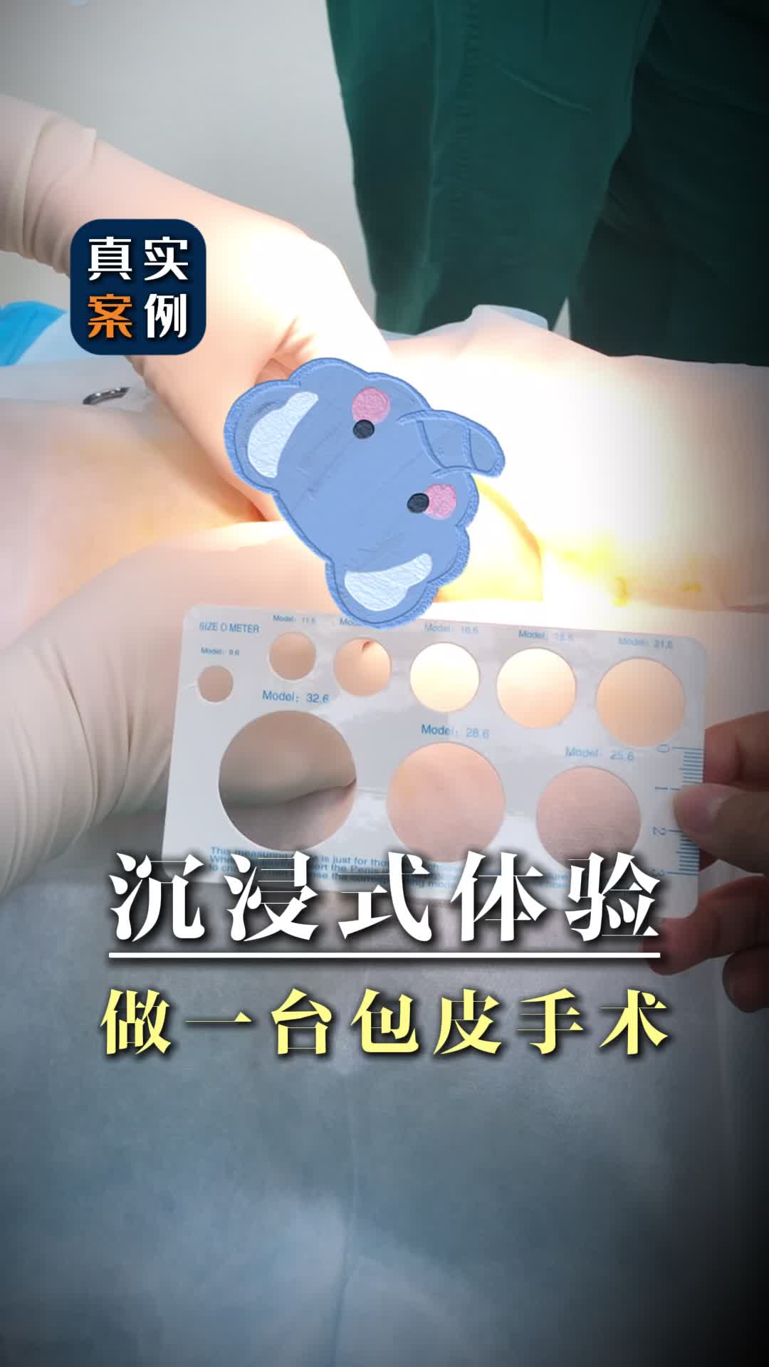 了解割包皮的过程!