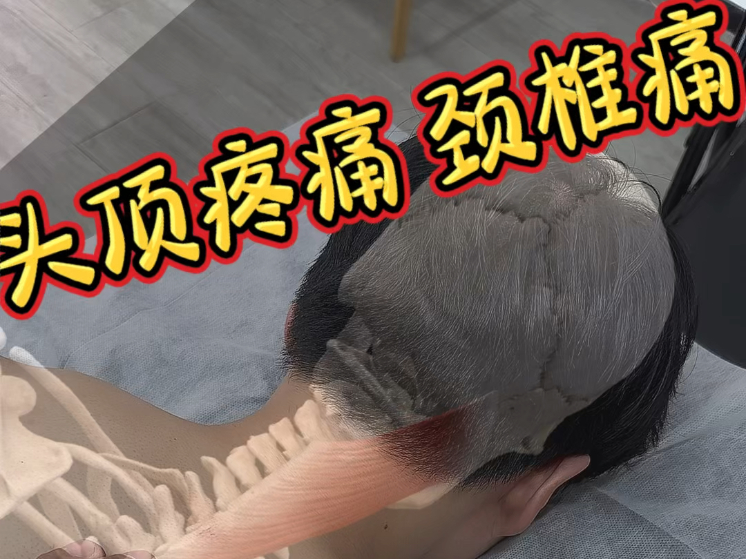 头顶疼痛 头皮紧 颈椎痛(头夹肌松解)