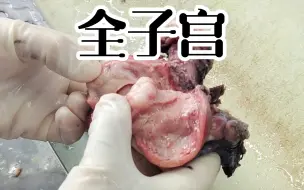 Download Video: 有的子宫肌瘤必须切除子宫的。这个肌瘤可让人好找！最后还是找到了！