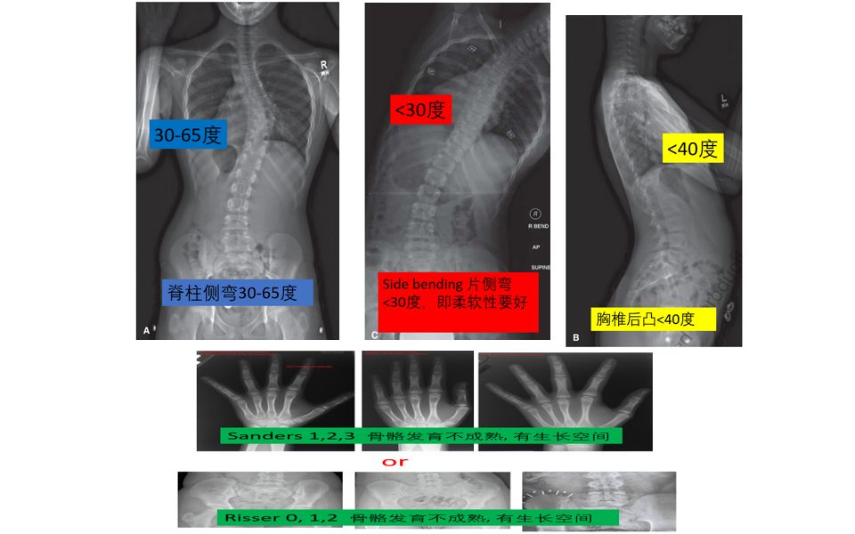 脊柱侧弯在什么情况下适合椎体拴系(VBT)非融合技术? 答案来了 一张图看明白哔哩哔哩bilibili