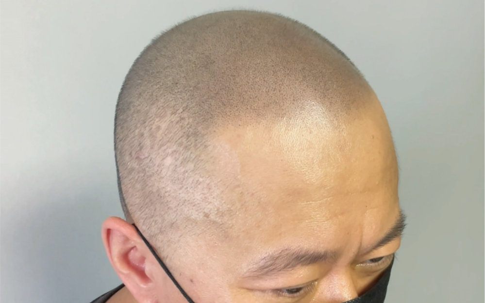 北京纹发后的光头案例