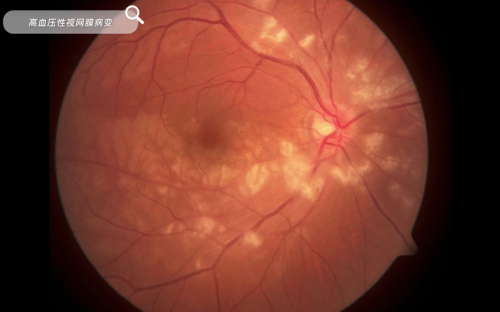 高血压性视网膜病变