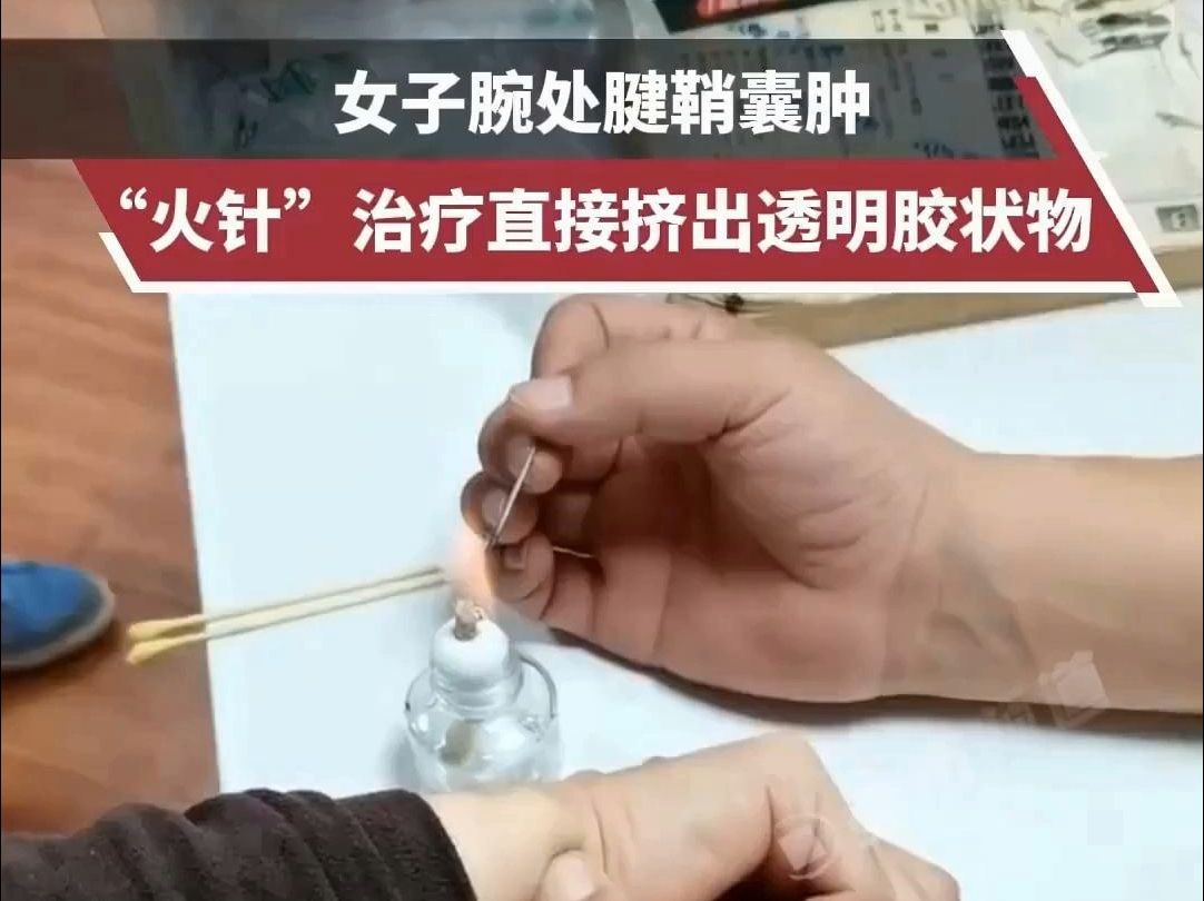火针--女子腱鞘囊肿