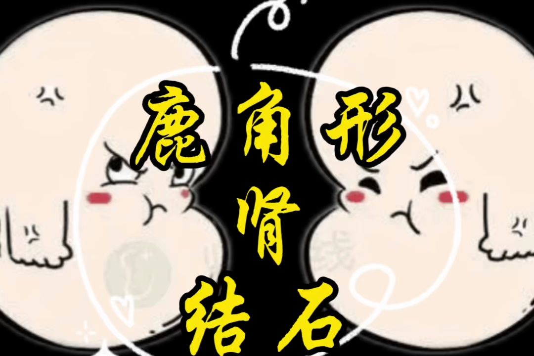 鹿角形肾结石哔哩哔哩bilibili