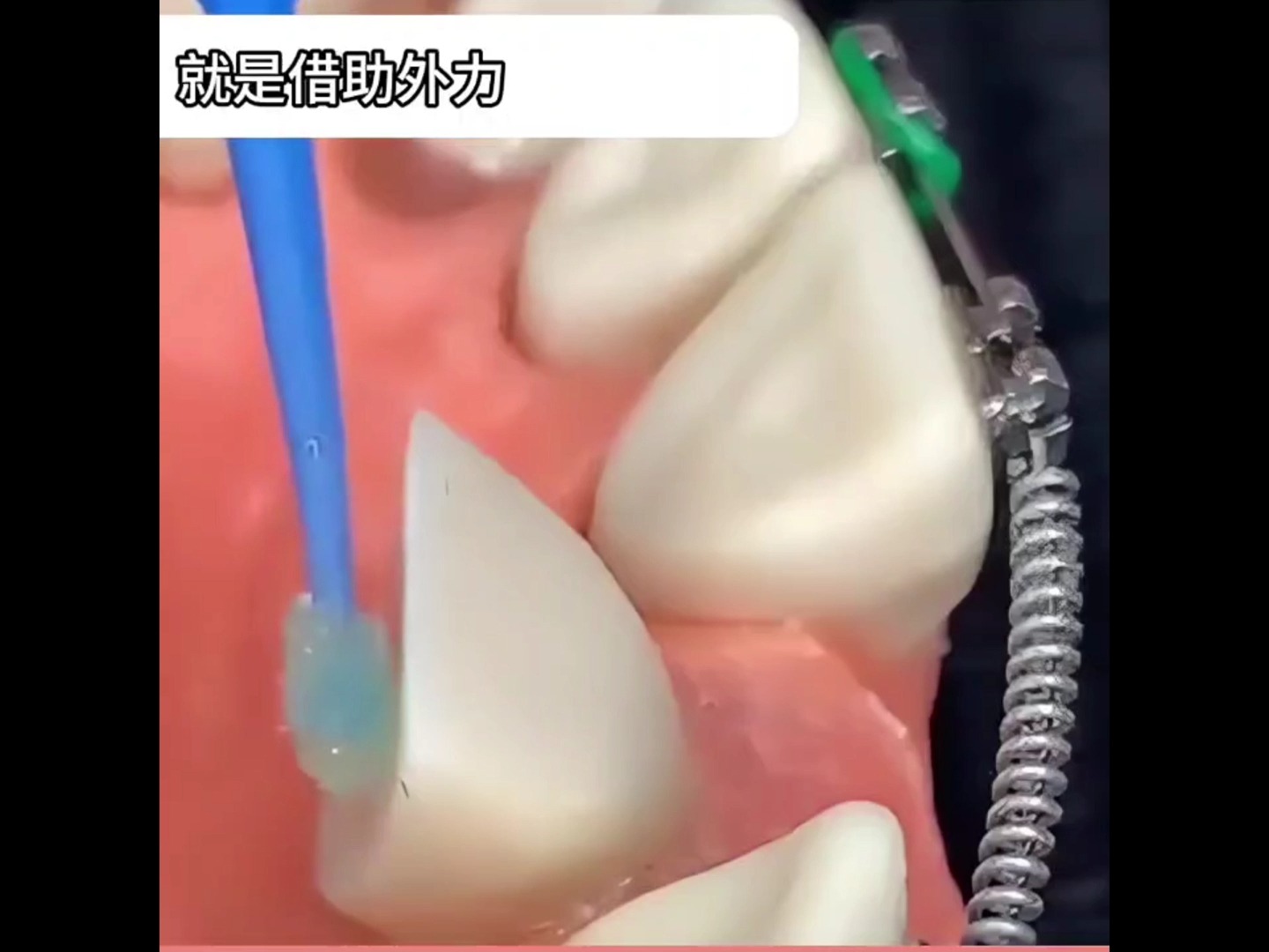 正畸牵引怎么做?看完你就知道了