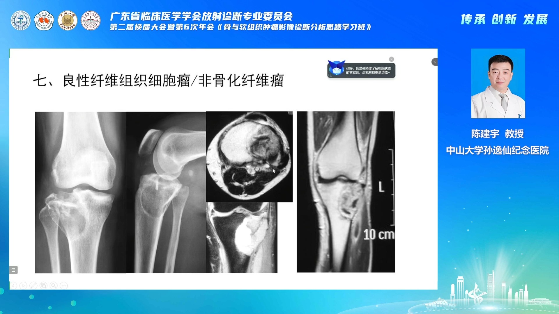 骨皮质病变影像学鉴别诊断思路:基于X线平片综合诊断陈建宇哔哩哔哩bilibili