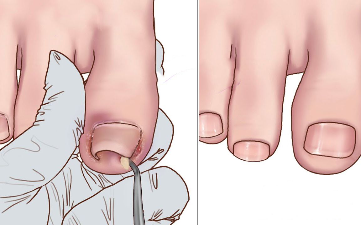 嵌甲修足护理动画 | ingrown toenail animation | way a