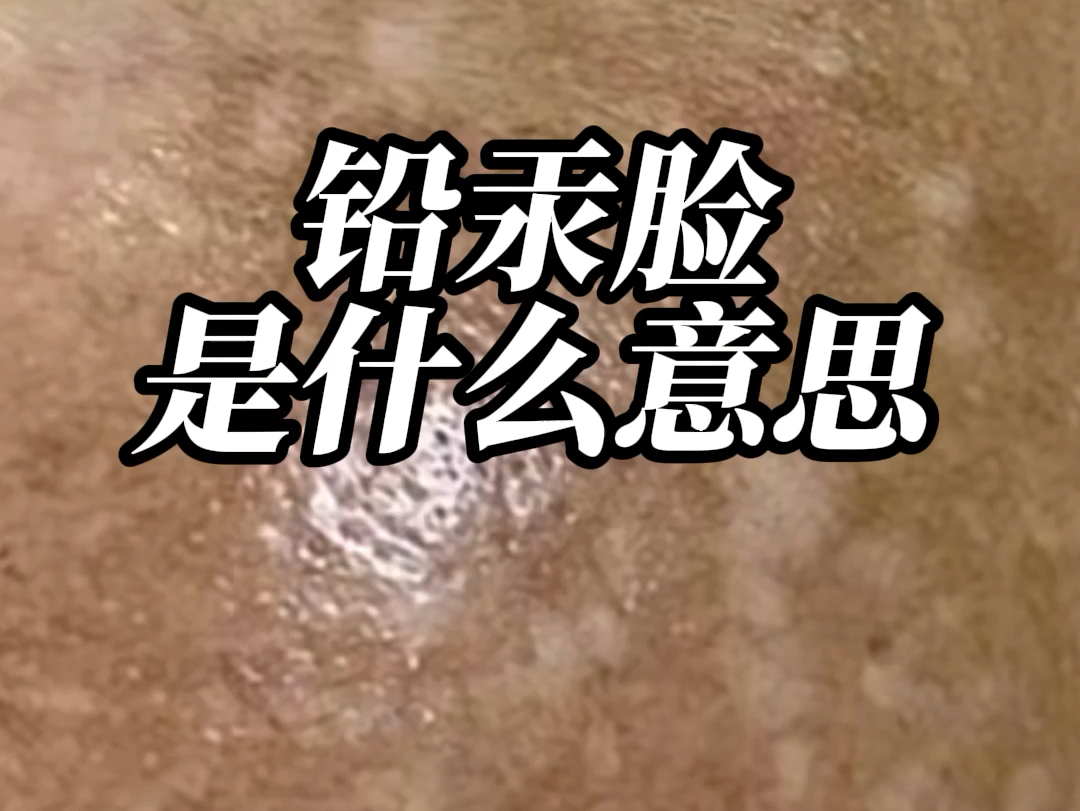 铅汞脸是什么意思?怎么治愈铅汞斑?