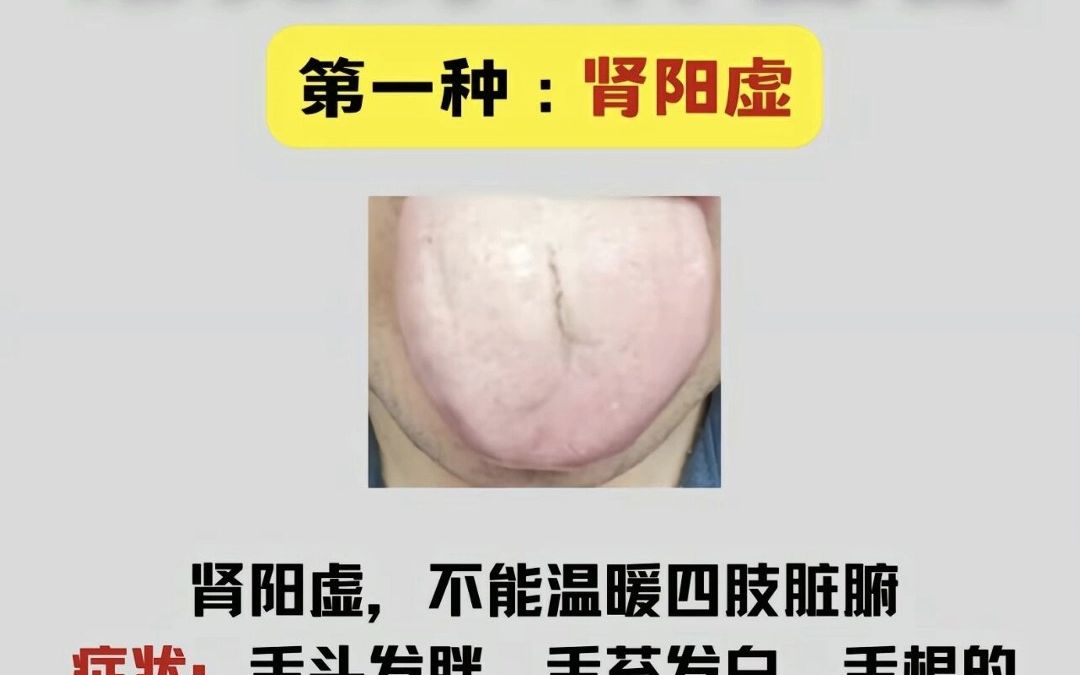 4種腎虛舌頭,對照看看你屬於哪一種?