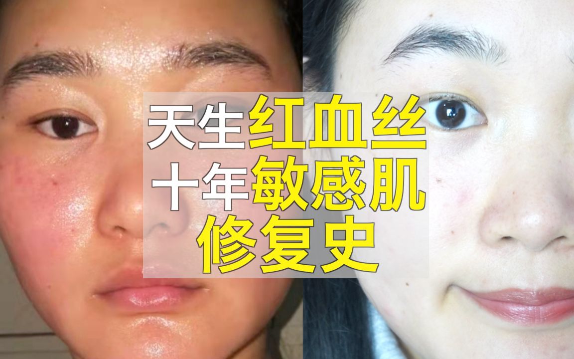 [图]天生红血丝敏感肌修复史❗没人比我更惨了❌天生的红血丝能治愈吗？ 需不需要用医美手段去除？也经常跑医院，用了各种方法 现在终于接近健康皮肤了❤红血丝也在逐渐的转好