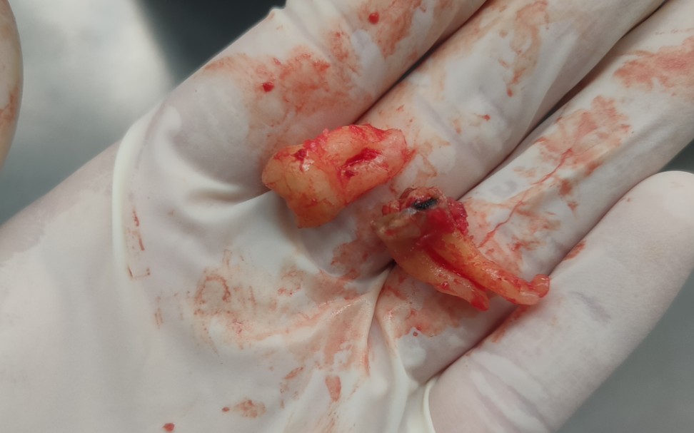 37残根正位38拔除