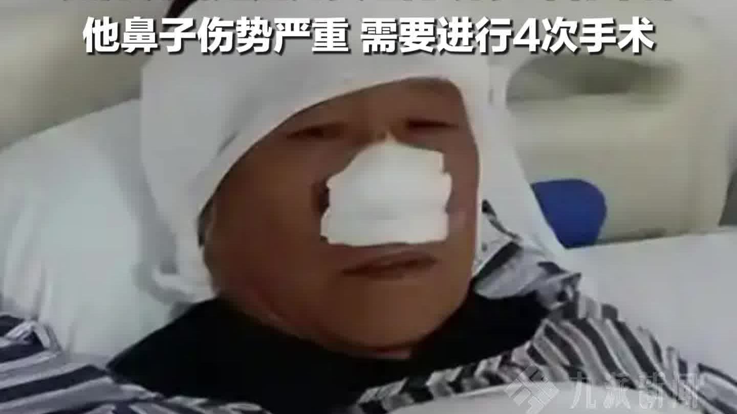 70岁老人挺身而出勇斗歹徒，鼻子被歹徒咬掉还吞进肚子里