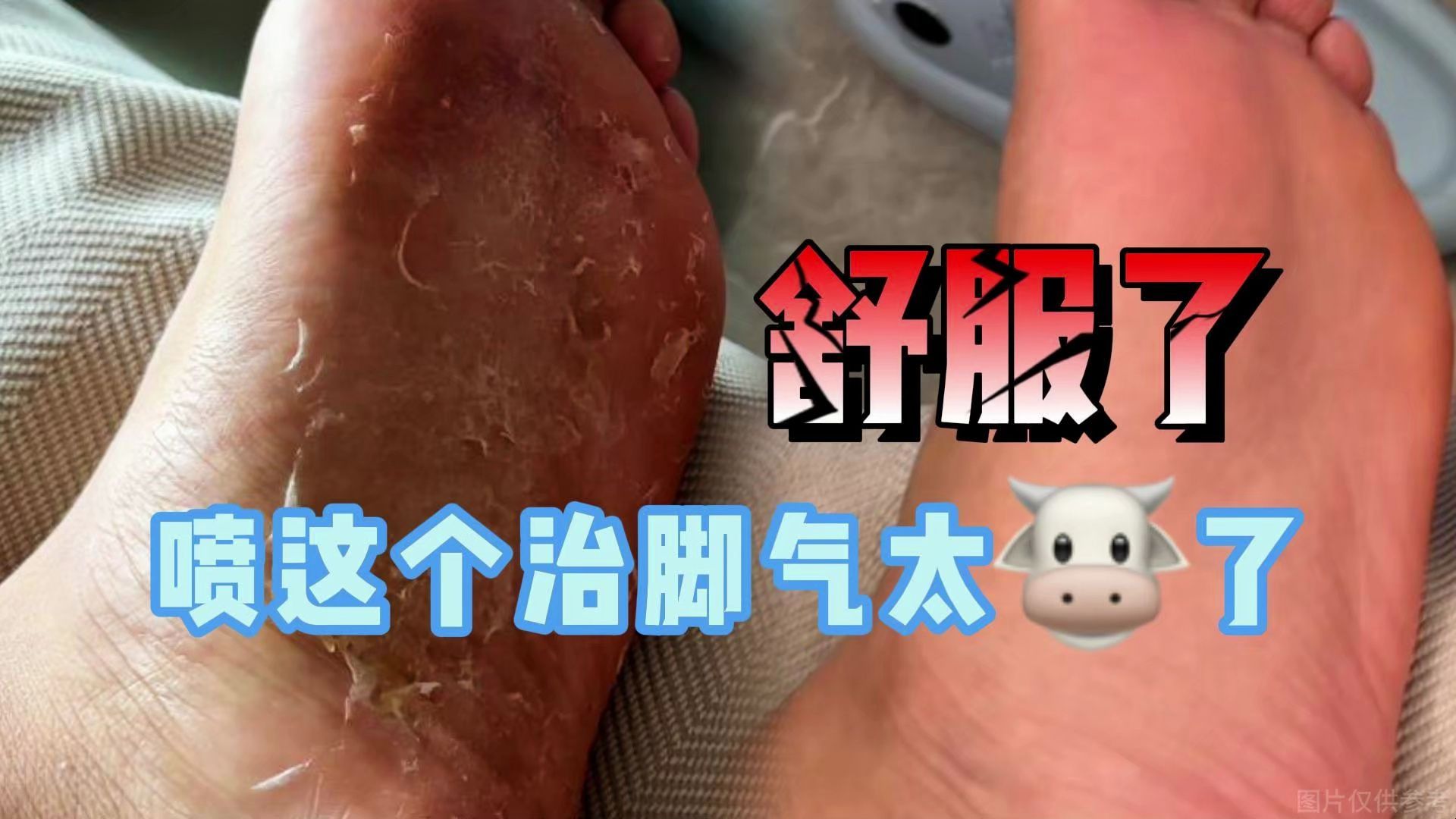 为什么会烂脚