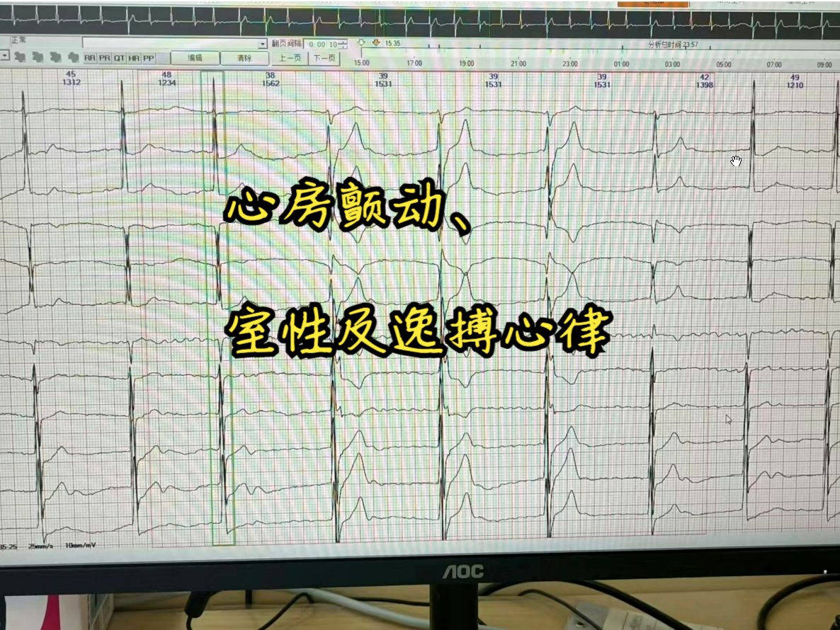 心房颤动、室性逸搏及心律哔哩哔哩bilibili