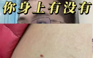 Download Video: 你身上有没有这样的血管瘤？我是有的