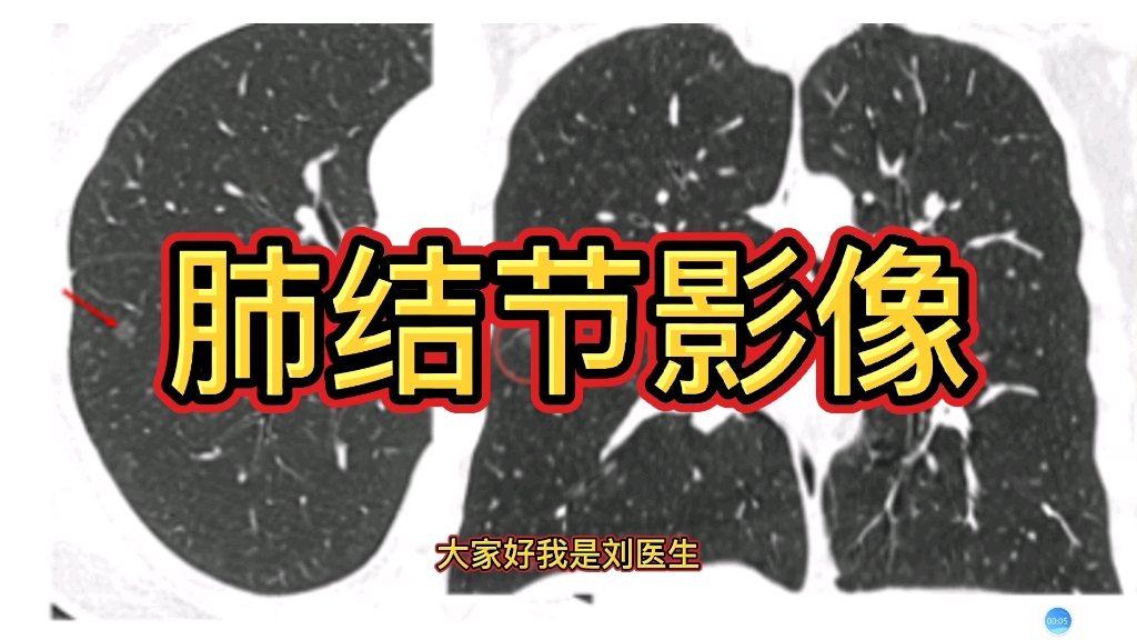 肺结节CT病例分享，看看这几例肺结节有何不同？医生讲解！-影像科刘医生-影像科刘医生-哔哩哔哩视频
