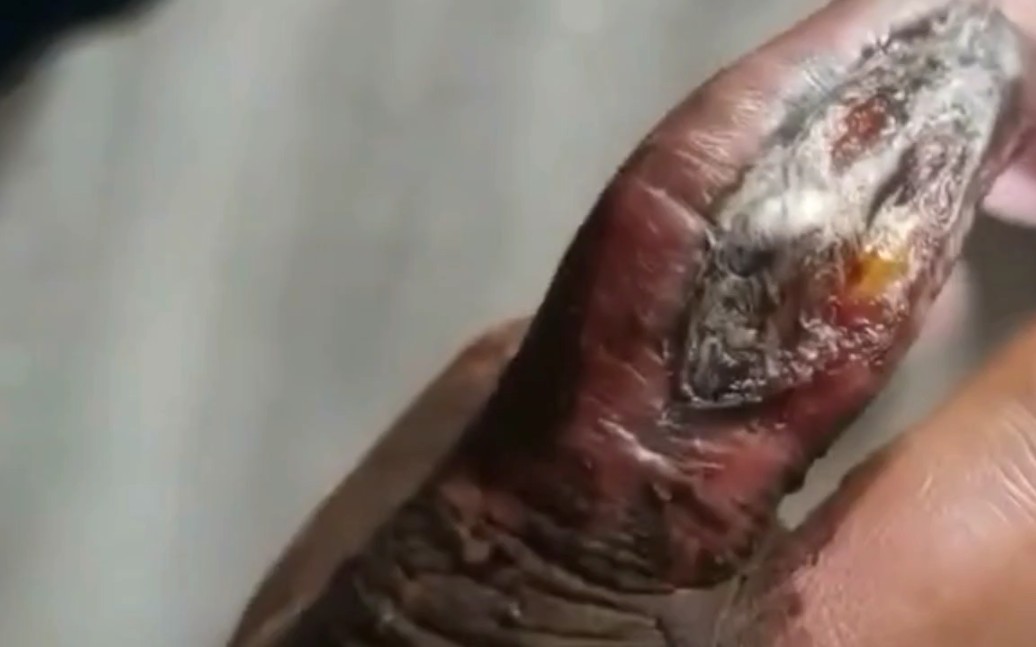 五步蛇咬伤有多恐怖,这手指就是被五步咬后烂肉恢复过程,肯定会留下一