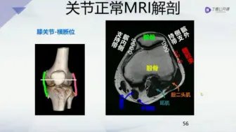 Скачать видео: 超重点超高清半月板MRI读片教学