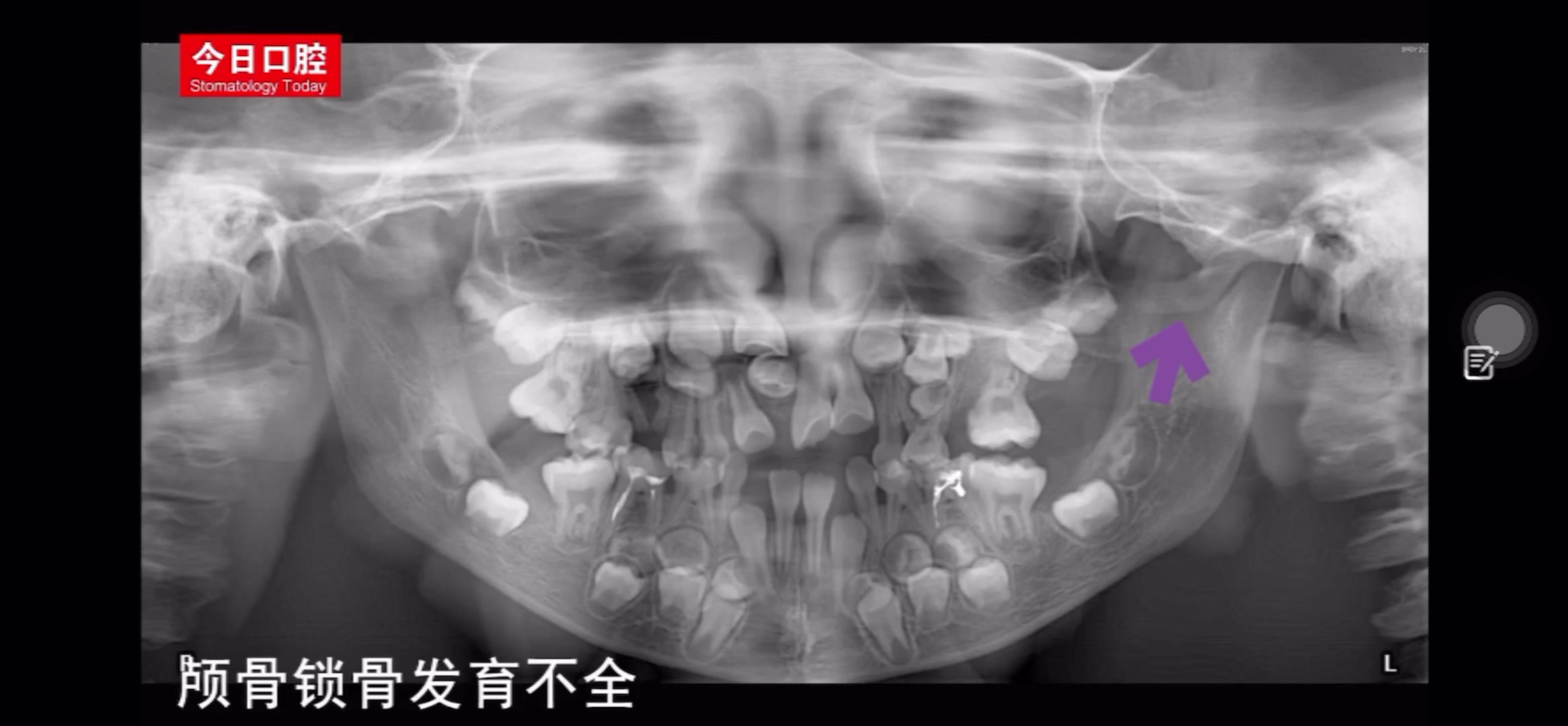 【口腔医学影像】牙齿发育异常的影像学表现哔哩哔哩bilibili