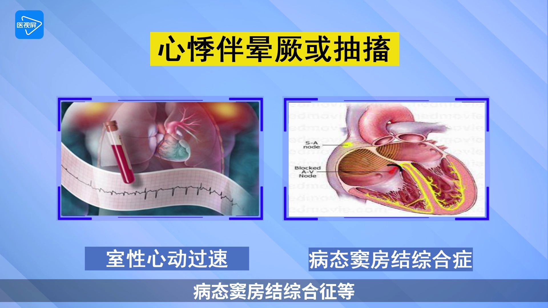 [图]第11节： 心悸的五大诊断提示