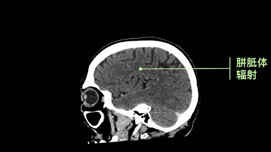 脑部ct胼胝体白质