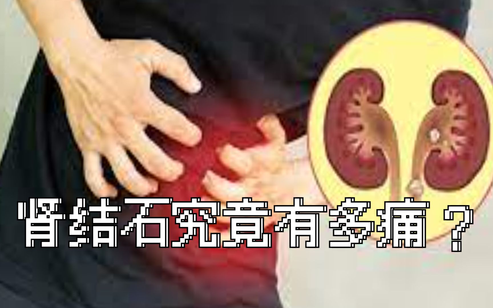 肾结石究竟有多痛?哔哩哔哩bilibili